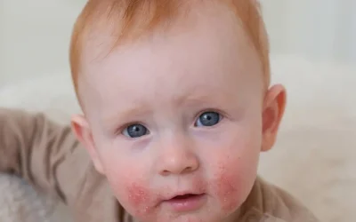Periorálna dermatitída: príčiny, príznaky a účinná starostlivosť o podráždenú pokožku